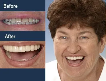 Alabama Dentist - porcelain crowns gold medal design