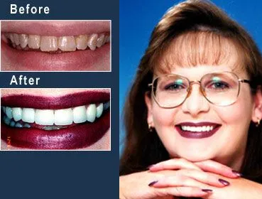 Alabama dentist - porcelain veneers