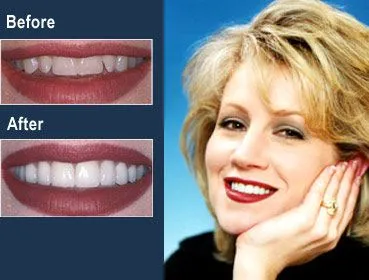 Alabama dentist porcelain veneers