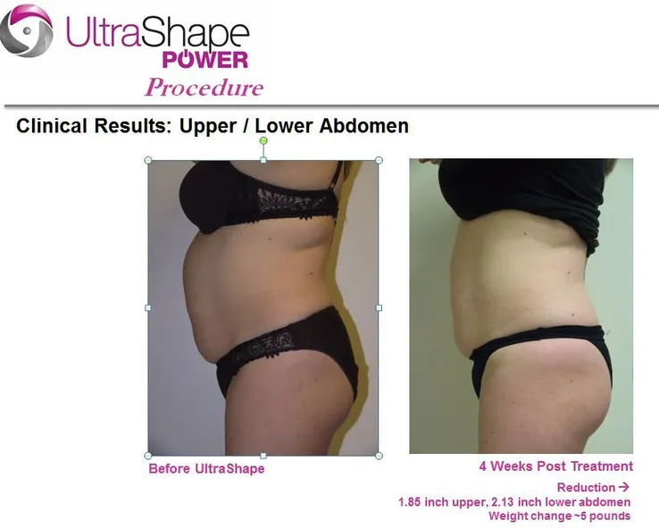 UltraShape