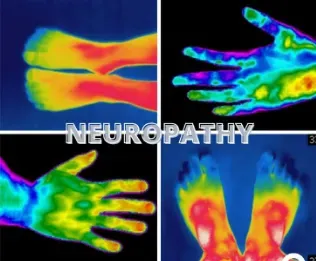 neuropathy