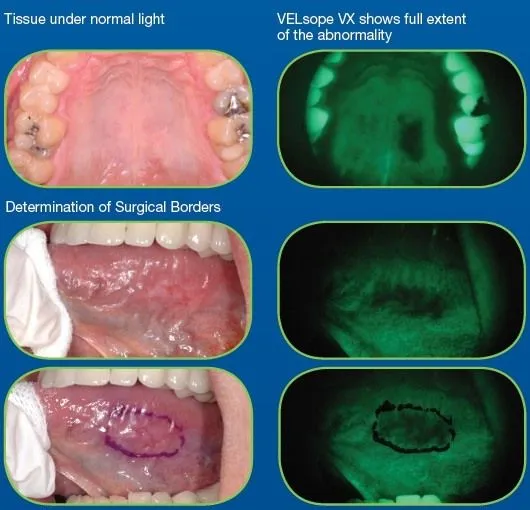 VELscope imaging