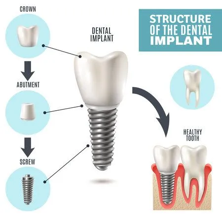 "Structure of the Dental Implant" diagram showing implant parts and placement, dental implants Bartlett, IL dentist