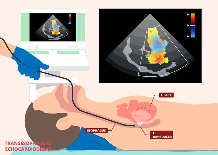 Transesophageal Echocardiogram (TEE)