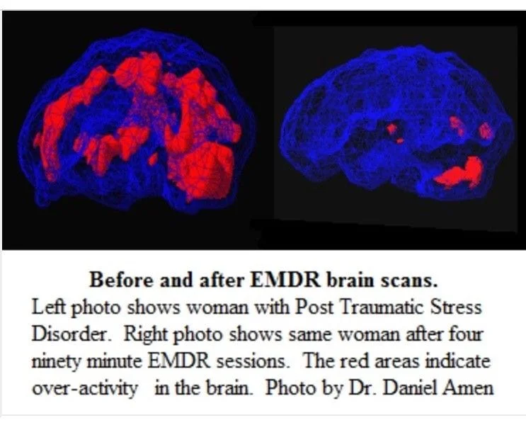 EMDR Brain Scan