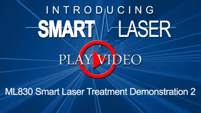 SmartLaserVideo10-700x394.png