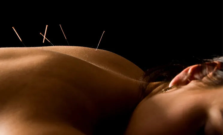 Acupuncture