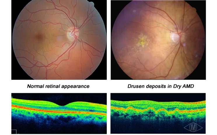 retinal photo and oct images of macular deg