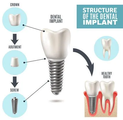 illustrated diagram "Structure of the Dental Implant" showing implant parts and placement, dental implants Cockeysville, MD dentist