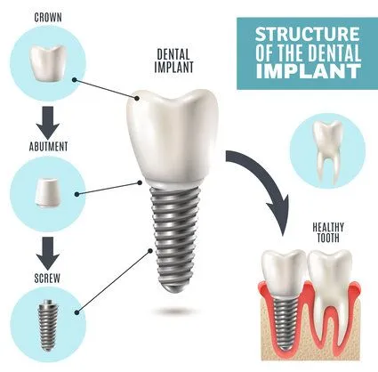 Illustrated diagram "Structure of the Dental Implant" showing implant parts and assembly, dental implants Novi, MI dentist