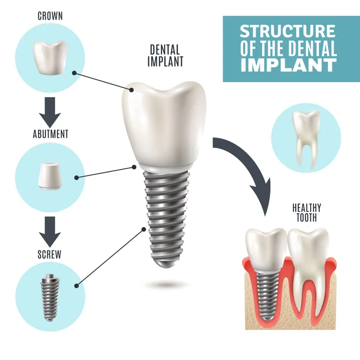 Illustrated diagram "Structure of the Dental Implant" showing implant parts and placement in gums, dental implants Truro implant restoration 