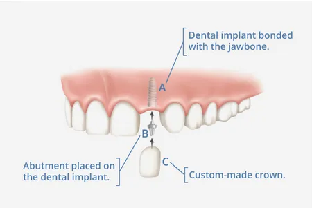 labeled diagram showing implant parts being placed in jawbone, dental implants Katy, TX dentist