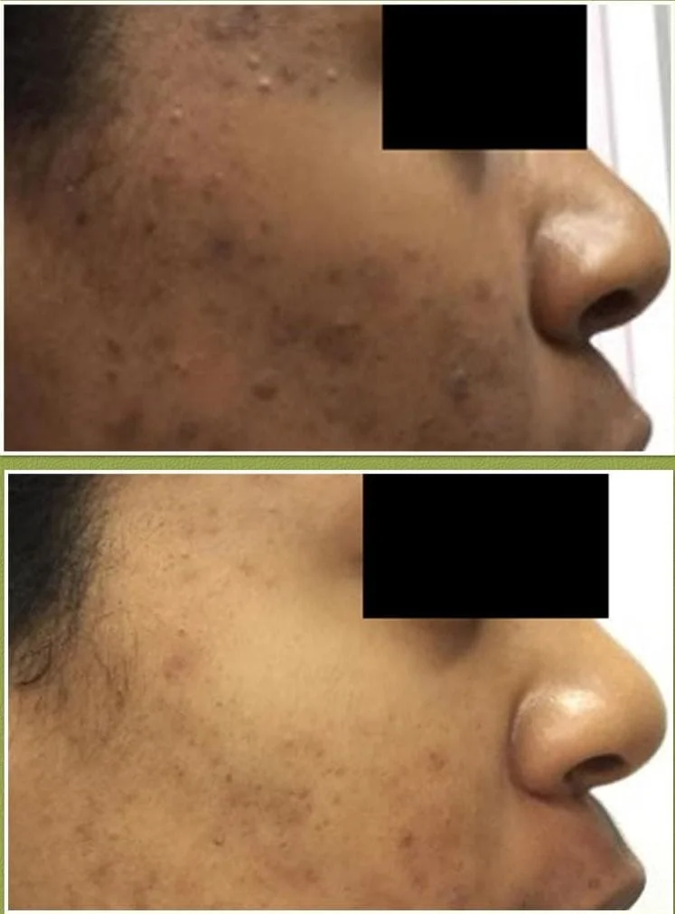 Treatment for Acne & Discoloration
