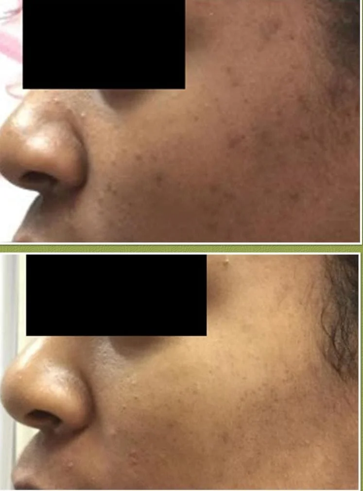 Treatment for Acne & Discoloration