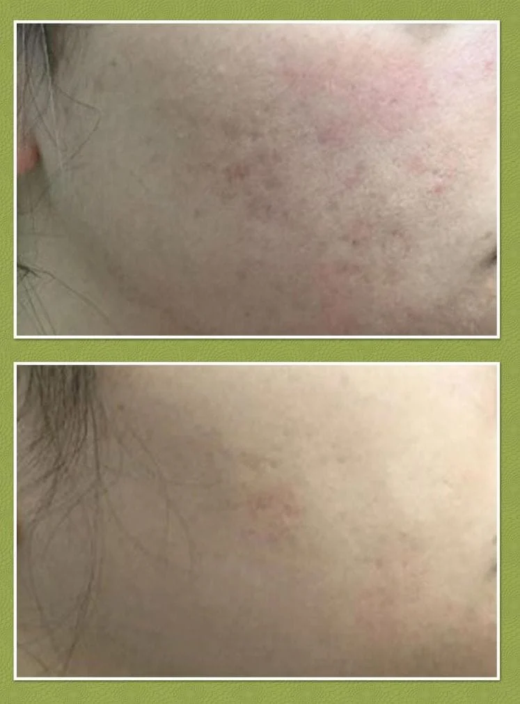 Microneedling (for acne scarring)