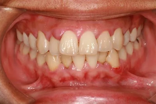 gum disease