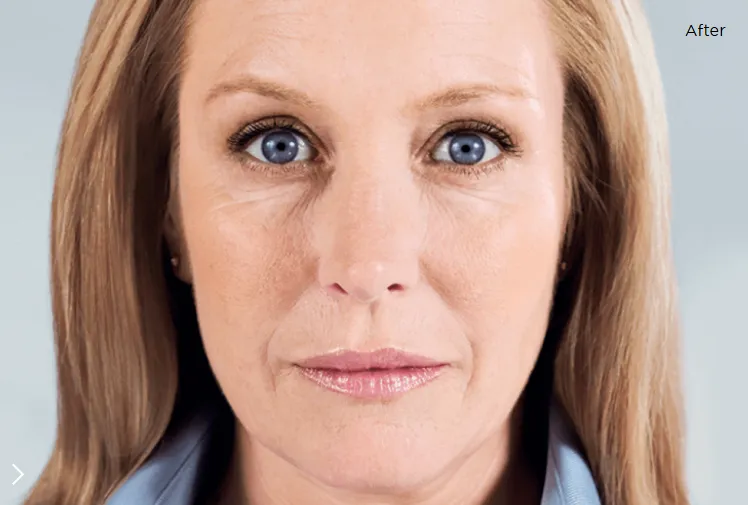 Sculptra 6 months later