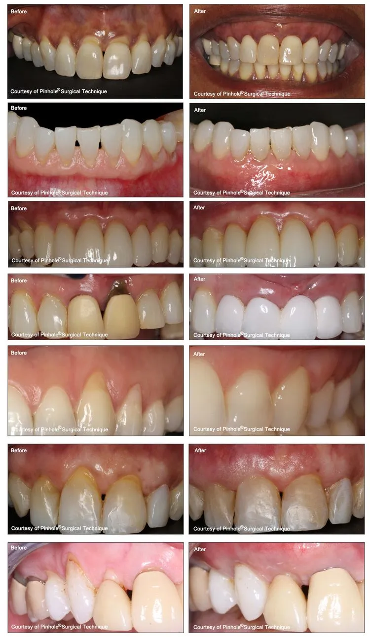 Gum Recession