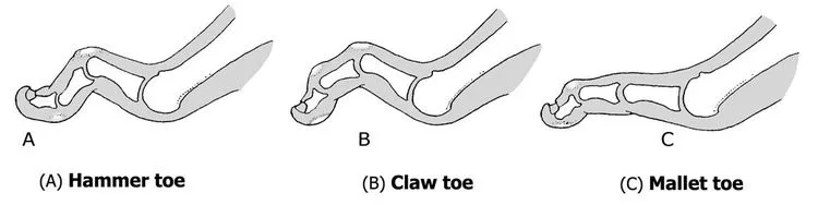 Hammer Toes/Claw Toes - Dr Warren