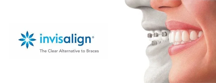 Overbite Correction with Clear Aligners in Thousand Oaks