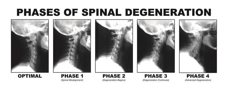 18901 Chiropractor | 18901 chiropractic Spinal Degeneration |  PA |