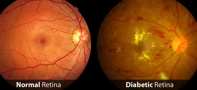 DM Retinopathy