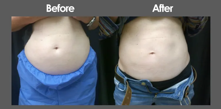 CoolSculpting