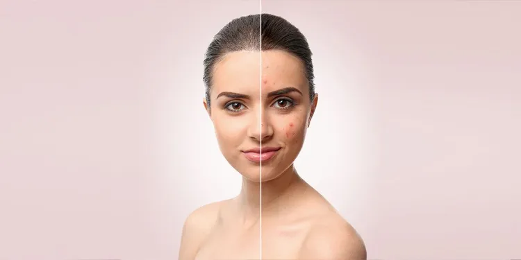 Acne before and after