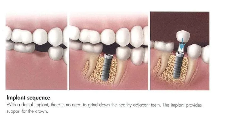 Manchester, NH Dental Implants