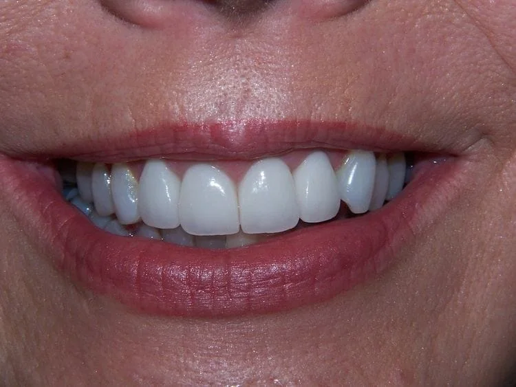 Guest 2: Patient did not like appearance of front teeth. Four all ceramic crowns were placed. 