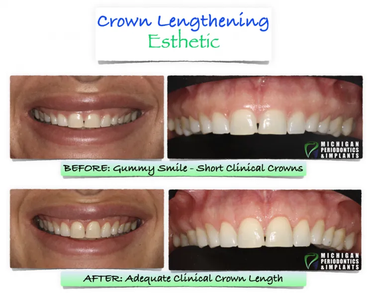 Before & After Same day crowns Wakefield MA