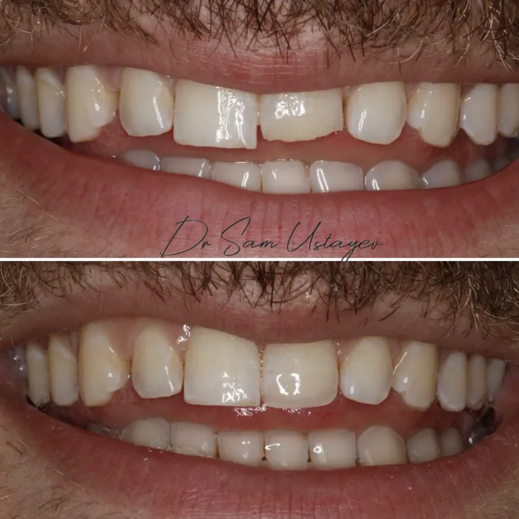 Front tooth chipped and fixed with bonding