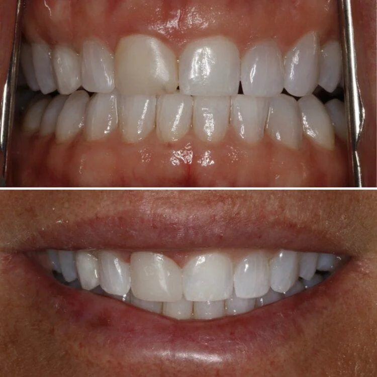 Before and after front tooth composite restoration