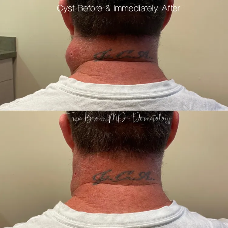 cyst before & after