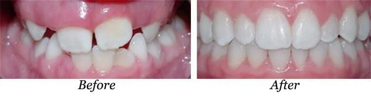 Walled Lake, Wixom, Novi Orthodontic Treatment before and after.