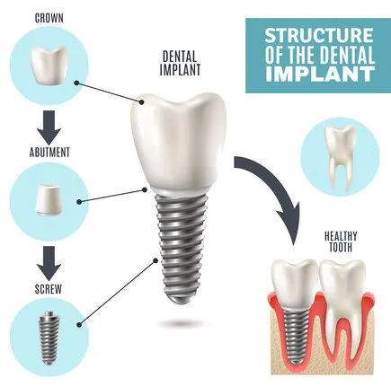 "Structure of the Dental Implant" illustrated diagram showing implant parts and placement, dental implants Boulder, CO dentist