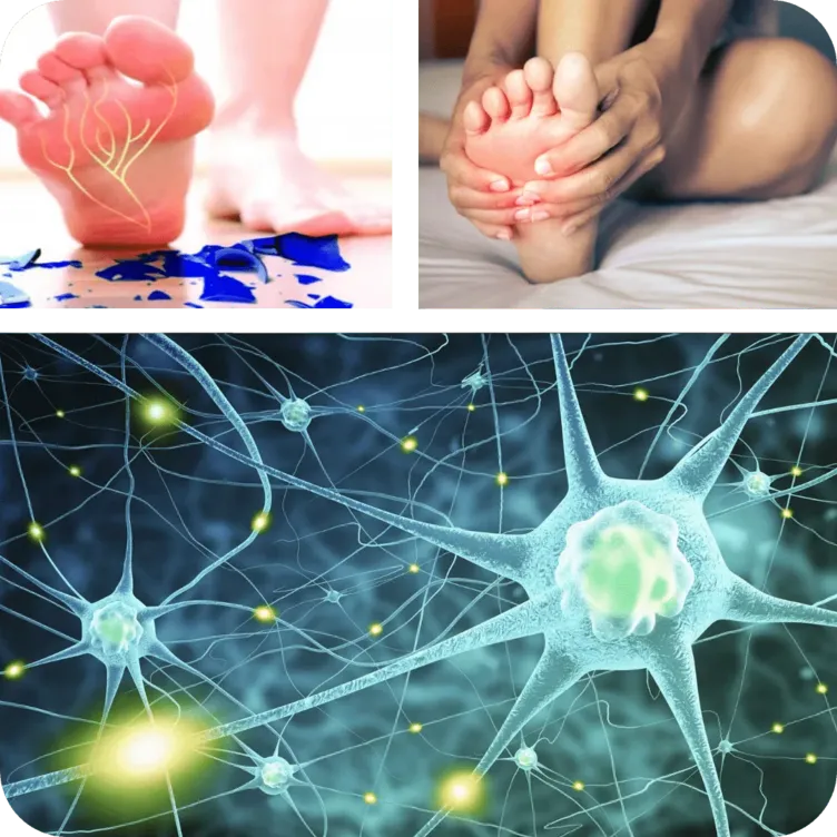 neuropathy