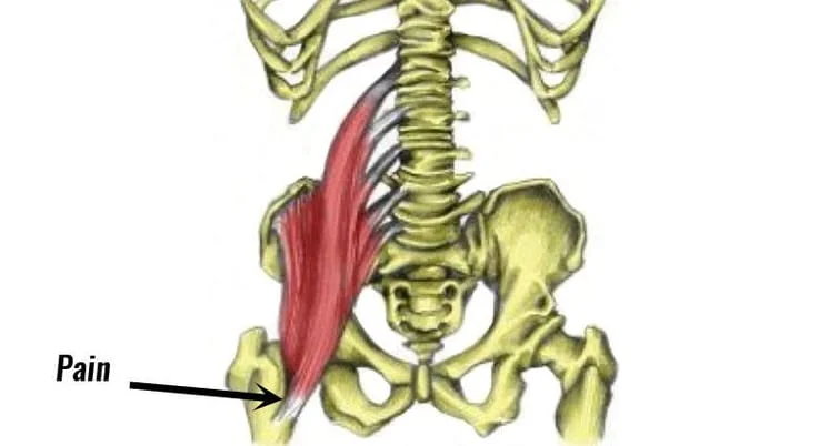 iliopsoas