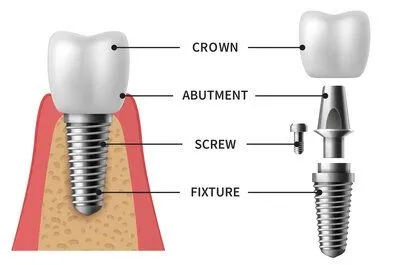 illustration of parts of dental implant, parts are labeled, dentist Decatur, IL dental implants