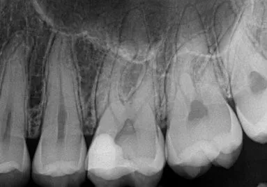 CEREC xrays waukesha, WI