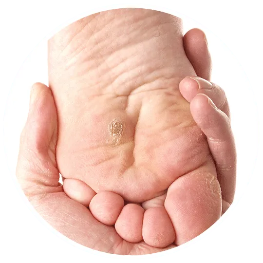 plantar wart