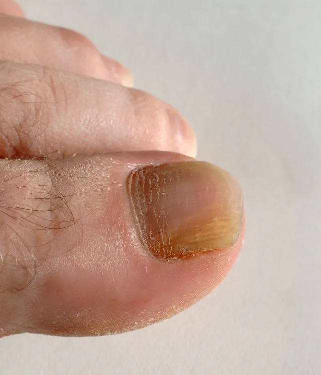 Fungus toenail