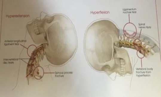 Whiplash or CAD injury (cervical acceleration deceleration