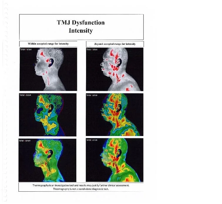 Thermography -- TMJ Dysfunction Intensity