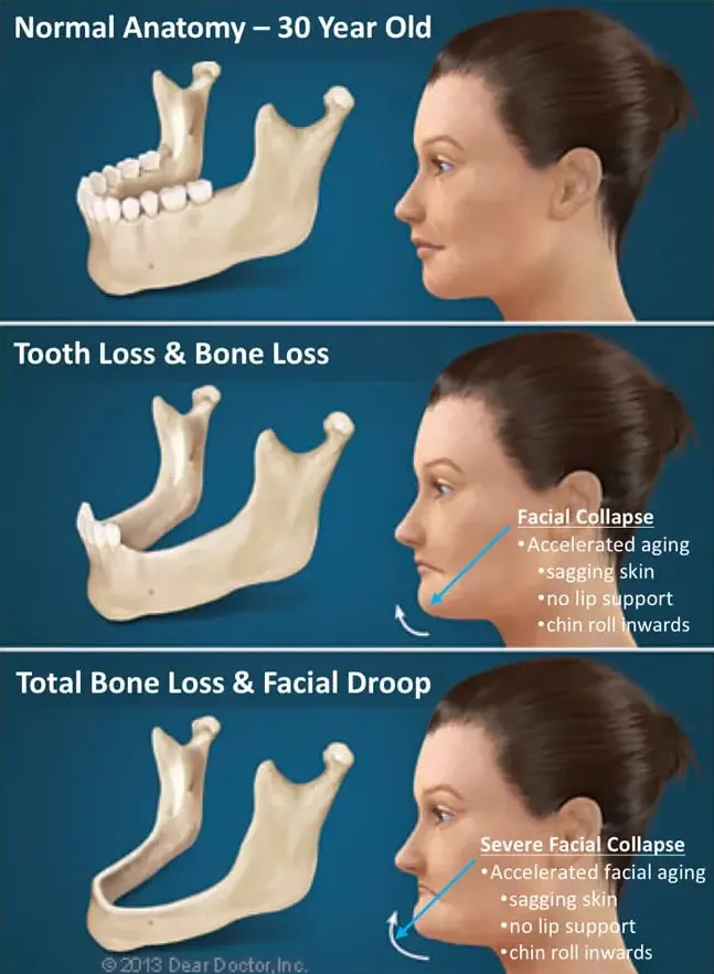 dental implant procedure fort lauderdale fl