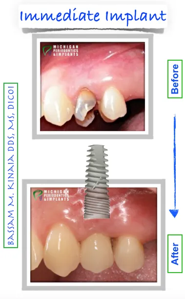 Before & After Dental implants Clinton | Washington | Shelby Township MI