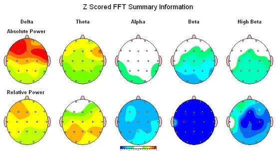 QEEG - Brain Mapping