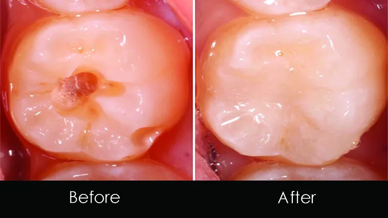 Before and After Filling