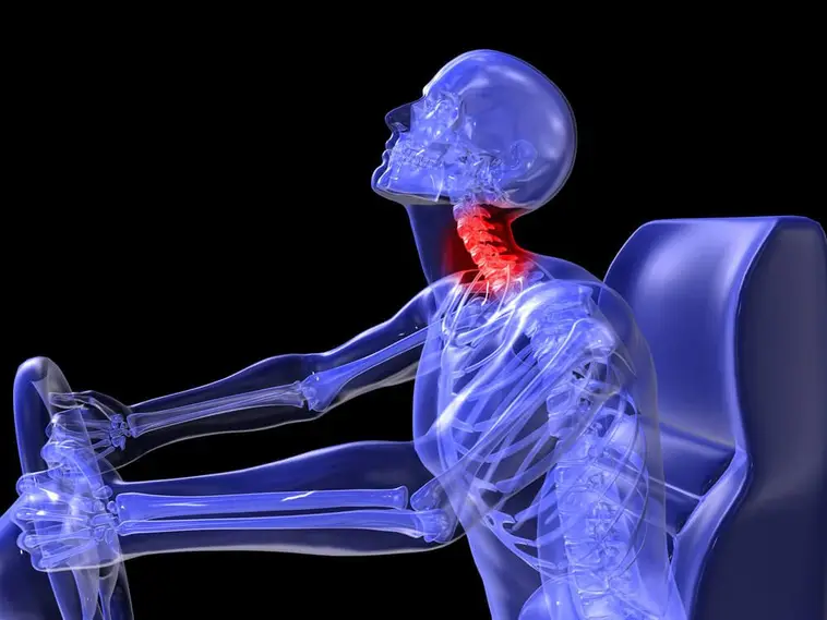 Medical illustration of human skeletal suffers from whiplash after getting into an auto accident.