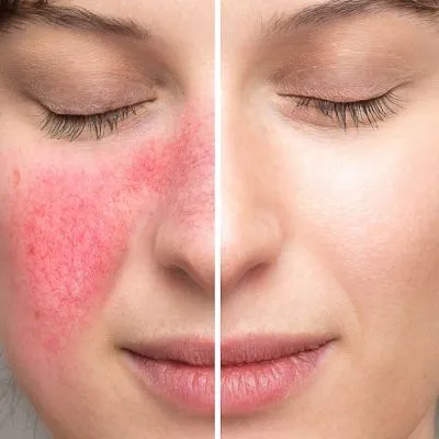 Rosacea in Phoenix, AZ